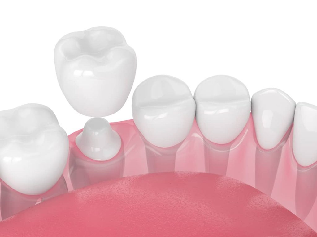 A dental model shows a row of teeth with a dental crown positioned above one of them, highlighting the process of dental restorations. The gum area is depicted in pink, emphasizing oral health care.