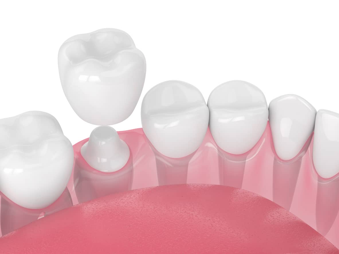 Dental crown placement showing tooth restoration with adjacent natural teeth and gum tissue