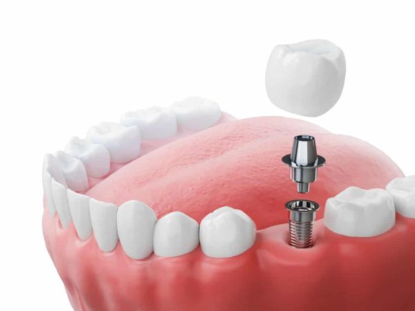Dental implant components showing abutment, screw, and crown restoration for tooth replacement at our dental clinic.