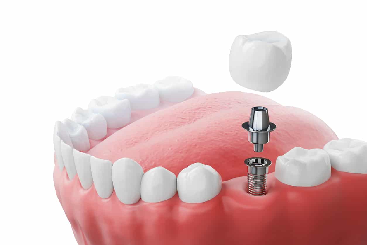 Dental implant components showing abutment, screw, and crown restoration for tooth replacement at our dental clinic.