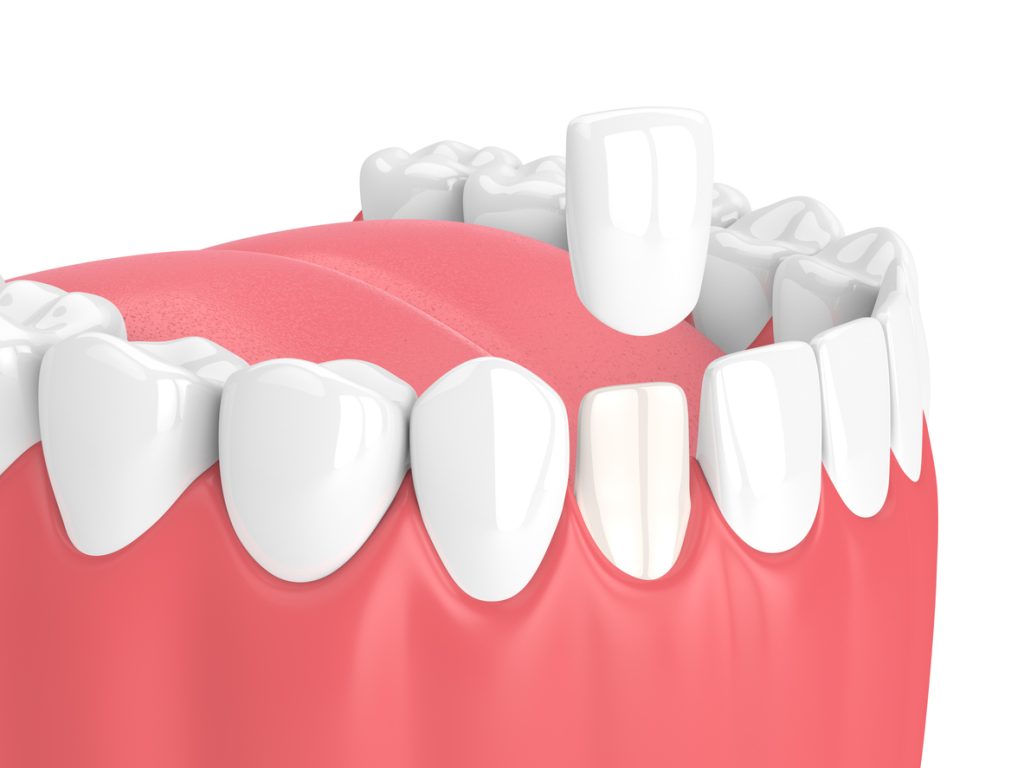 A close-up illustration of a dental model showing a healthy set of teeth and gums, with one tooth in the process of receiving a dental crown. The image emphasizes dental health and treatment procedures.