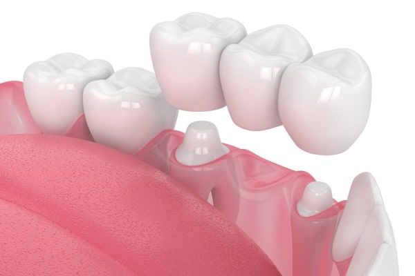 Dental bridge procedure showing missing tooth replacement at our clinic
