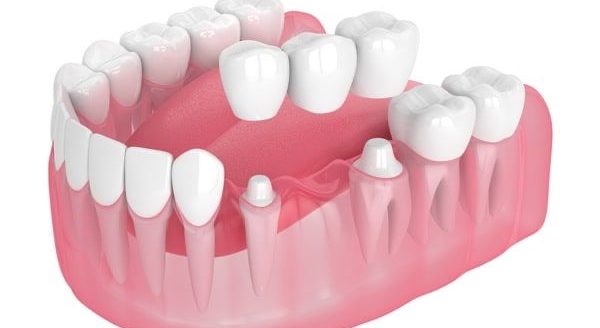 Dental bridge restoration showing bridge and crown placement on jaw model at our dental clinic