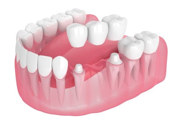 Dental bridge restoration showing bridge and crown placement on jaw model at our dental clinic