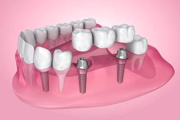 Dental implant model showing prosthetic teeth and implant posts on pink gum base