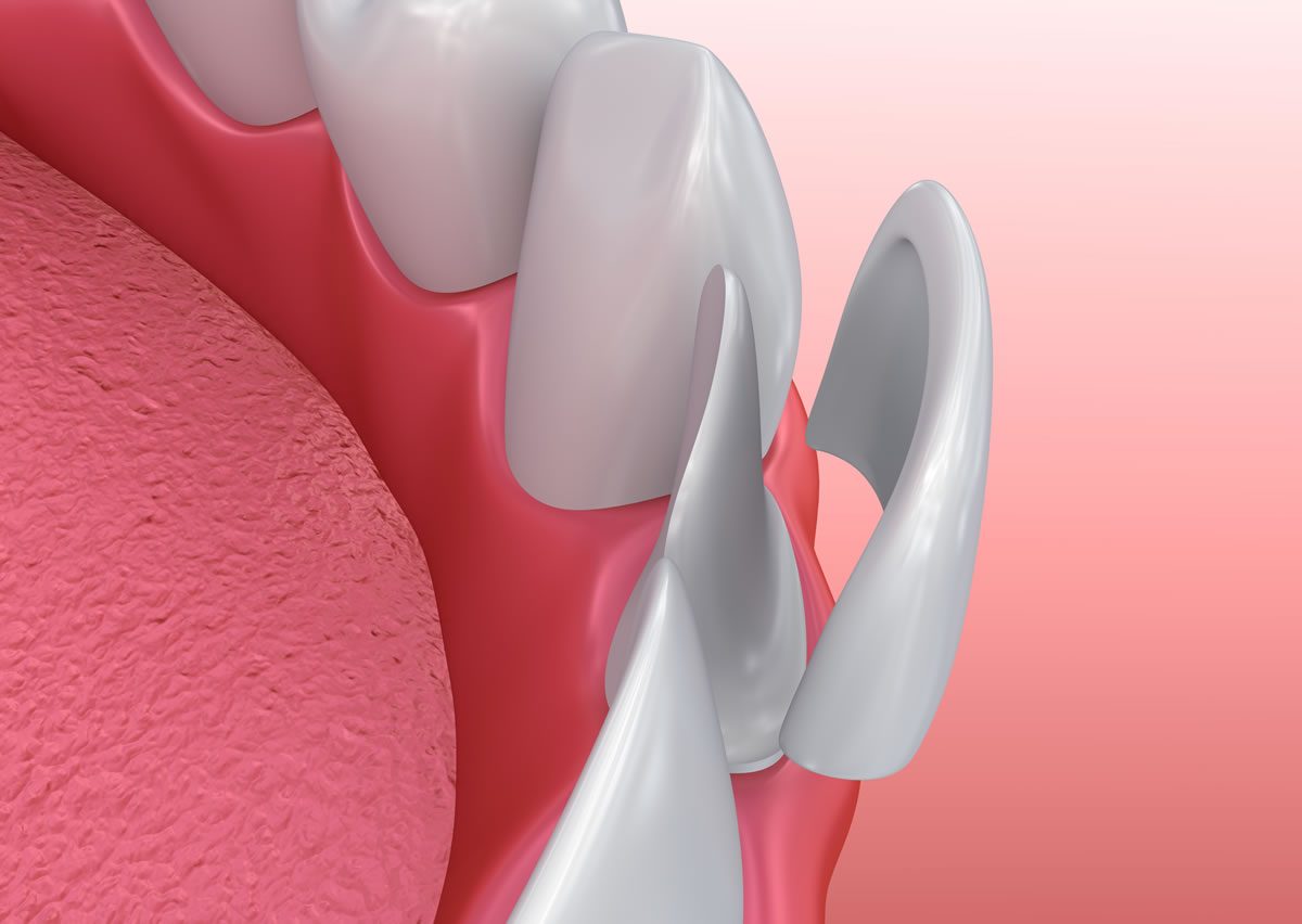 3D illustration of dental veneer