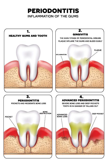 Periodontitis stages: healthy gums, gingivitis, periodontitis, and advanced periodontitis with bone loss