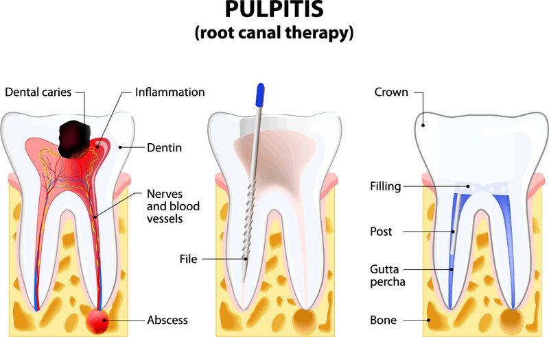 Pulpitis root canal therapy diagram showing dental caries, inflammation, and treatment steps with filling and gutta percha placement.