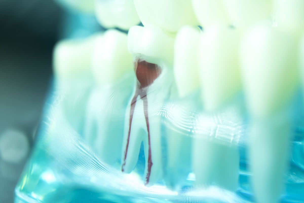 Simulation of root canal outline